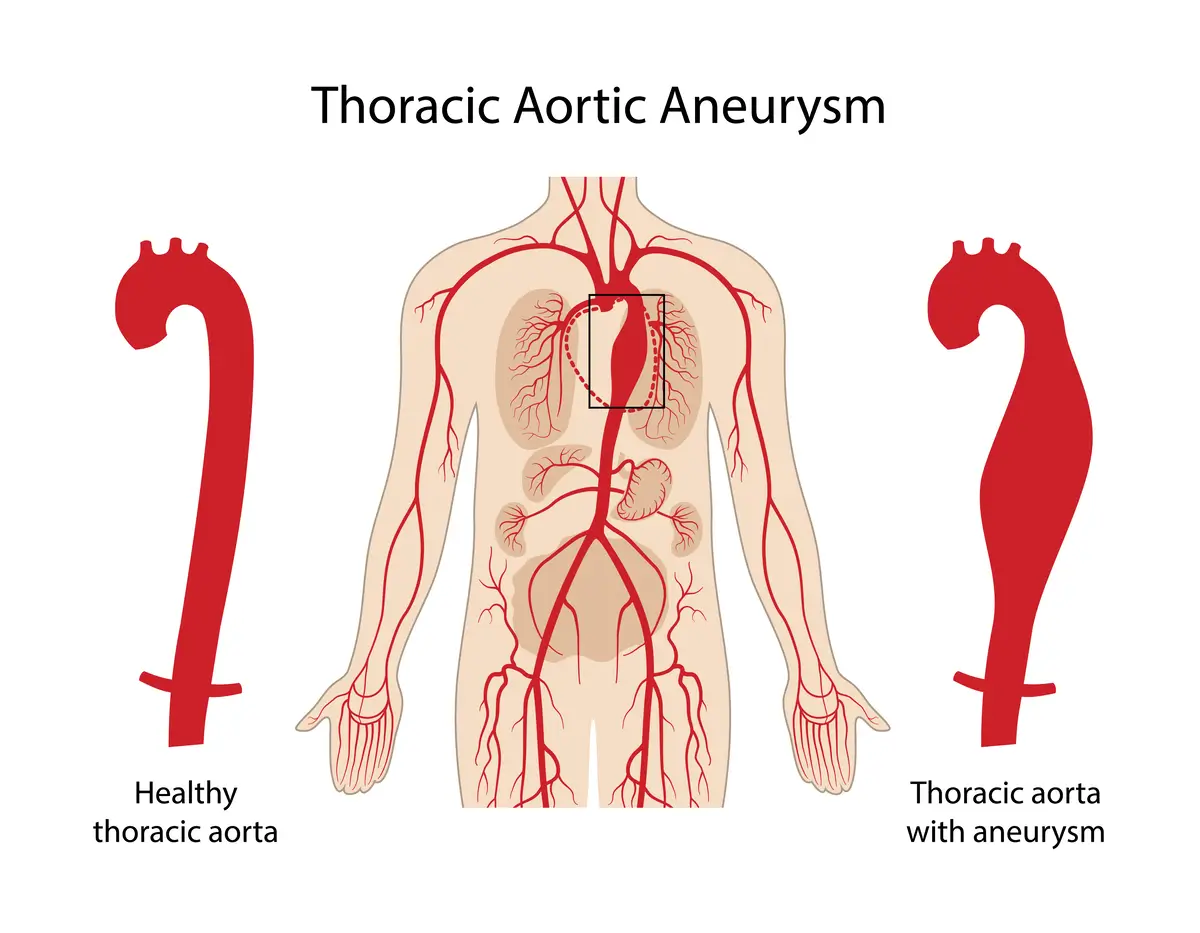 Types of Aortic Disease - Thoracic Aortic Aneurysm (TAA) | https://www.harleystreet.sg/